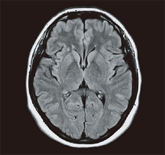 頭部FLAIR(フルデジタル)のMRI写真