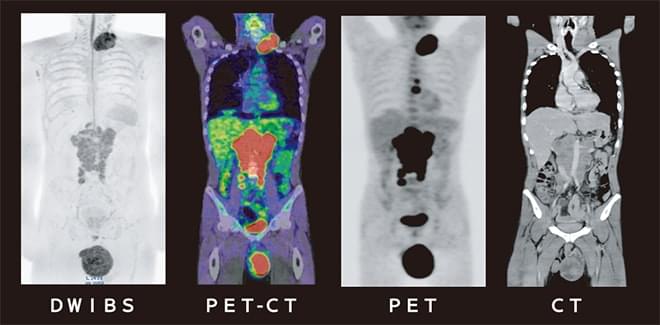 DWIBS、PET-CT、PET、CTそれぞれの画像比較