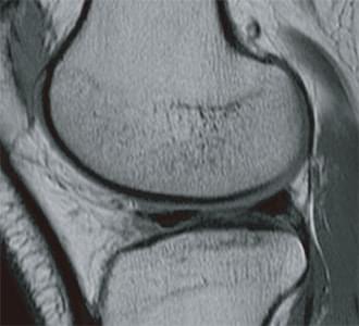 膝関節(アナログ)のMRI写真