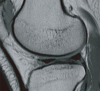 膝関節(アナログ)のMRI写真