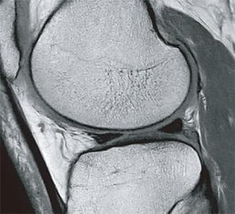 膝関節(フルデジタル)のMRI写真