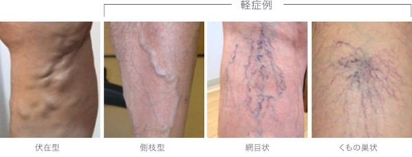 健康な足のために 下肢静脈瘤という病気について 医療法人清幸会 三原城町病院